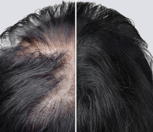 Baldness cure
