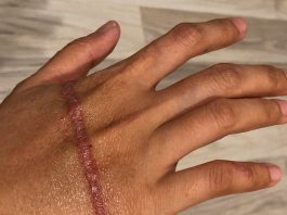 Box jellyfish sting