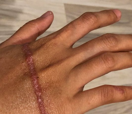 Box jellyfish sting