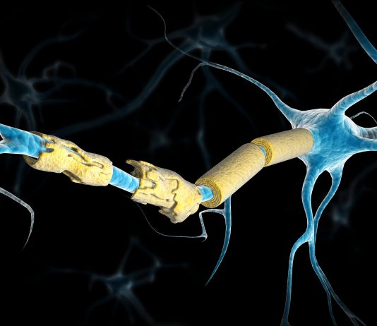 Epstein barr virus multiple sclerosis