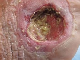 Maggots in wound care