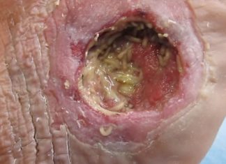 Maggots in wound care