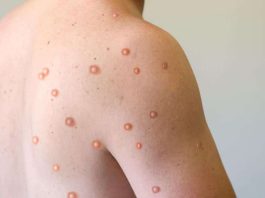 Monkey pox cases