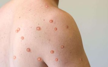 Monkey pox cases