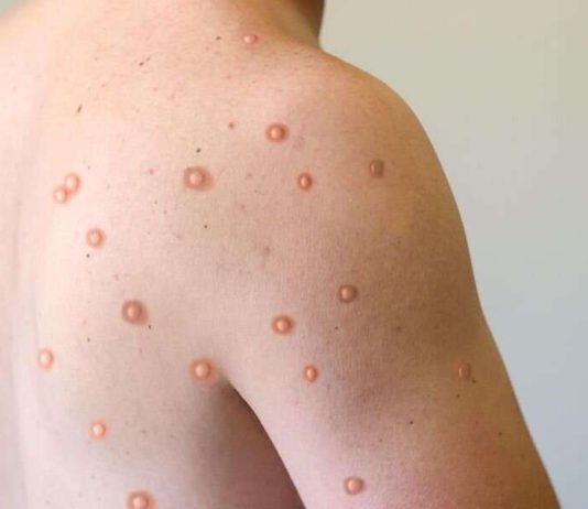Monkey pox cases