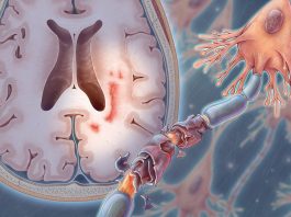 Multiple sclerosis