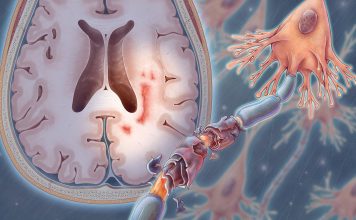 Multiple sclerosis